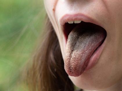 here is how the color of the tongue shows your disease | बापरे! जीभ काळीही पडू शकते? तुमची जीभ सांगतीये तुमचा आजार