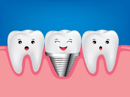 Dental implants in the cheekbone now with precision | आता अचूक पद्धतीने गालाच्या हाडात दंत प्रत्यारोपण