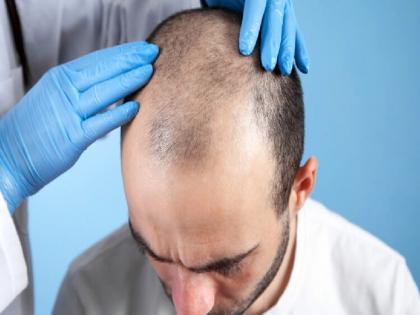 Hair transplants carried out in the name of 'ghost doctors' | ‘घोस्ट डॉक्टरां’च्या नावे चालविले जाते हेअर ट्रान्सप्लांट; डॉक्टर केवळ नावालाच