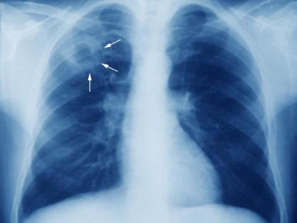 Punishment to hospitals not registering tuberculosis | क्षयरुग्णांची नोंदणी न करणाऱ्या रुग्णालयांना शिक्षा