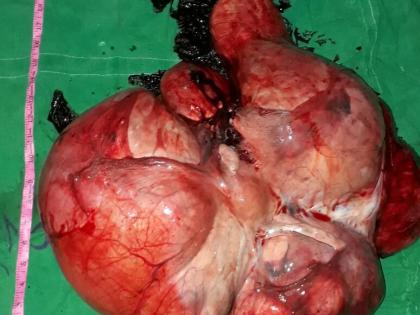 18 kilogram tumor removed from the stomach of a woman in Nagpur | नागपुरात महिलेच्या पोटातून काढला १८ किलोचा ट्युमर