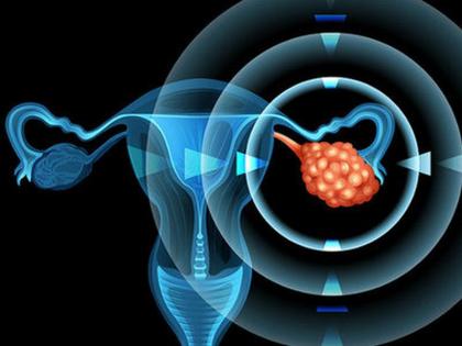 Football shaped tumor removed from the stomach | आश्चर्य ! डॉक्टरांनी पोटातून काढला फुटबॉलच्या आकाराचा ट्यूमर