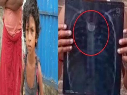 Coin stuck in girl's chest 4 years ago; Suddenly his health deteriorated | ४ वर्षापूर्वी मुलीच्या छातीत अडकलं होतं नाणं; अचानक तब्येत बिघडली, मग...