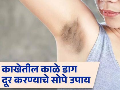 Get rid of dark spots in underarm with these home remedies | काखेतील काळे डाग दूर करण्याचे सोपे घरगुती उपाय, लगेच दिसेल फरक!