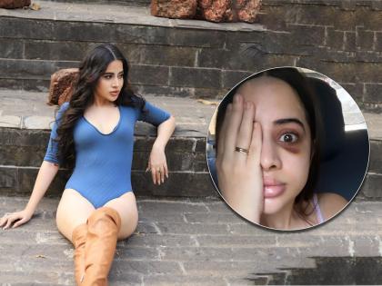 Uorfi javed face injured actress shared her photo on instagram see here | Uorfi Javedच्या चेहऱ्यावर कुणी मारला ठोसा? अभिनेत्रीची झाली अशी अवस्था, तिला ओळखणं ही झालं कठीण