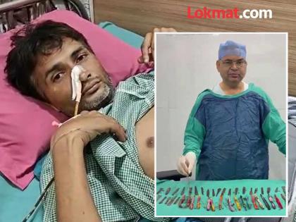 UP man swallows steel spoons toothbrushes Doctors perform 5 hour operation to remove 50 items | नशेत तरुणाने गिळले २९ स्टीलचे चमचे, १९ टूथब्रश; ५ तासांची शस्त्रक्रिया करून पोटातून काढल्या ५० वस्तू