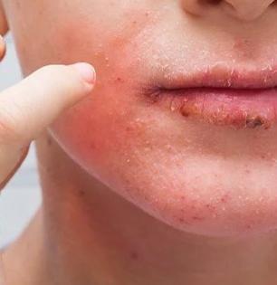 अप्पर लिप्सचे वॅक्स केल्यानंतर त्वचा लालसर होऊन रॅशेस येतात? सोप्या ३ टिप्स, आग होईल कमी
