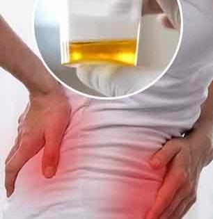युरिक ॲसिड वाढलं-किडनी स्टोनचा त्रास? ४ गोष्टी करा- किडनीच्या आजारांचा धोका टाळा