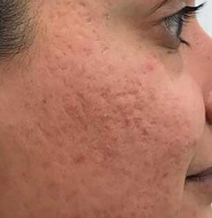 गालावरचे ओपन पोअर्स वाढल्याने चेहरा थोराड दिसतो? 'या' पानांचा लेप लावा- त्वचा दिसेल तरुण, सुंदर