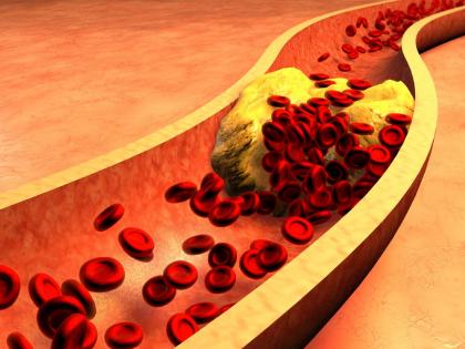 Best ways to prevent plaque buildup in our arteries myb | धमन्यांमध्ये जमा होणारं प्लाक ठरू शकतं हार्ट अटॅकचं कारण,असा करा बचाव