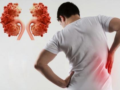 Kidney Cysts symptoms diagnosis and treatment myb | किडन्यांमध्ये पाण्याने भरलेले फोड येणं; असू शकतो 'या' आजाराचा धोका, जाणून घ्या लक्षणं