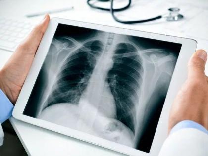 CoronaVirus : X-ray मार्फत कोरोनाचं निदान होणार, फक्त 5 मिनिटांत रिझल्ट मिळणार?