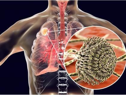 In Mumbai, the threat of aspergillosis and corona infection is declining | मुंबईत आता धोका अ‍ॅस्परजिलोसिसचा, कोरोनाचा संसर्ग कमी होत असताना आले नवे संकट