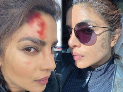 Priyanka Chopra was injured during the shooting and fans were shocked to see her condition | प्रियंका चोप्राला शूटिंगदरम्यान झाली दुखापत, तिची अवस्था पाहून चाहते झाले हैराण
