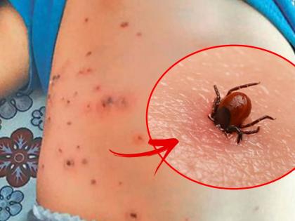 causes symptoms remedies of scrub typhus after corona danger of scrub typhus | कोरोना, डेंग्यू पाठोपाठ आता स्क्रब टायफसचा धोका, वेळीच लक्षणं जाणून घ्या नाहीतर ओढावेल मृत्यू