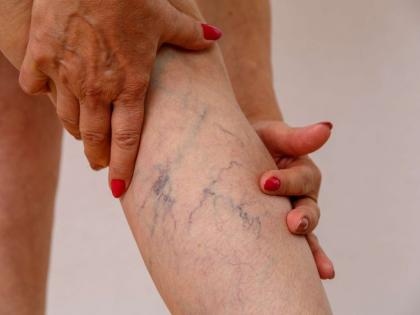 What problems do varicose veins cause | Varicose Veins : व्हेरिकोज व्हेन्स म्हणजे नेमकं काय? वेळीच व्हा सावध, ओळखा धोका; तज्ज्ञांचा सल्ला