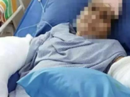 The father-in-law cut off both of daughter in law's hands with a sword, and the doctor reattached her after 9 hours of surgery | "मी पोलिसांना घाबरत नाही!" असं म्हणणाऱ्या सासऱ्याने सुनेचे दोन्ही हात तलवारीने कापले