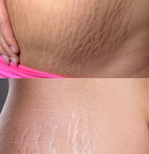 5 best ways to remove stretch marks from body