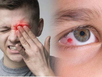 redness of the white part of the eyes may be sign of serious problem health tips | अलर्ट! तुमच्या डोळ्यांचा पांढरा भाग कधी कधी 'असा' लाल होतो?; गंभीर आजाराचं असू शकतं लक्षण 