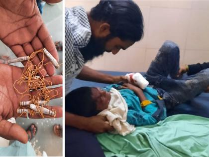 Shocking! The children attached the detonator to the battery of the mobile as a game; two were seriously injured in the blast | भयंकर! खेळ म्हणून मुलांनी मोबाईलच्या बॅटरीला जोडले डिटोनेटर; स्फोटात दोघे गंभीर जखमी