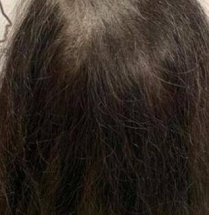 Hair Growth Tips : केस खूप गळताहेत, टक्कल पडण्याची भिती वाटते? ४ उपाय दाट, मजबूत केस राहतील कायम
