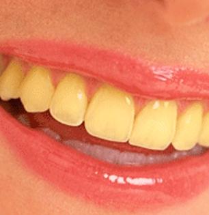 दातांचा पिवळटपणा दूर करेल 'ही' घरगुती टुथपेस्ट; दात दिसतील पांढरेशुभ्र- चमकदार