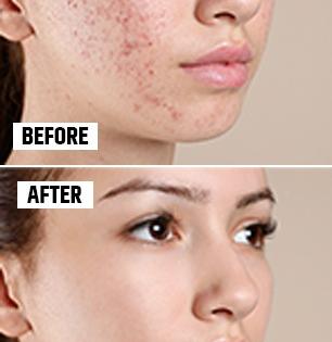Alum for Skin : फक्त ५ रुपयांची तुरटी वापरून मिळवा ग्लोईंग, डागविरहीत चेहरा; डाग, काळपटपणा होईल दूर