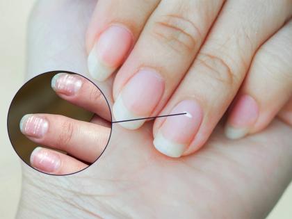 What do spoon-shaped nails reveal about your health? - Doctor Rekha