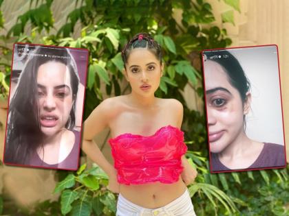 Swollen face, dark circles under the eyes...fans were shocked to see the condition of Urfi Javed | सुजलेला चेहरा, डोळ्याखाली काळी वर्तुळं...उर्फी जावेदची अवस्था पाहून हैराण झाले चाहते