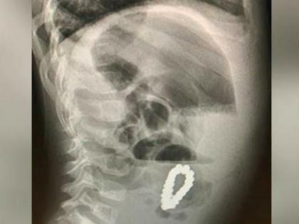 boy swallow magnetic bracelet 4 year old complains of stomach pain doctors find magnetic bracelet inside | धक्कादायक! 4 वर्षीय मुलाच्या पोटात सापडलं मॅग्नेटिक ब्रेसलेट, एक्स-रे पाहून डॉक्टरही हैराण