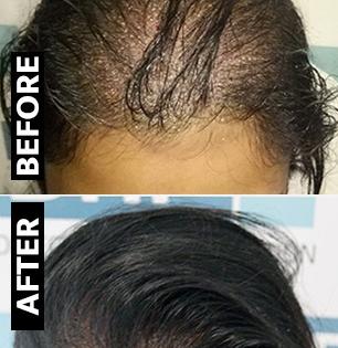 पातळ केसांमुळे टक्कल पडण्याची भिती वाटते? १ चमचा दही, आवळ्याचा पॅक लावा, दाट होतील केस