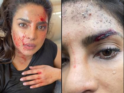 Fans were shocked to see Priyanka Chopra's condition with bruises and traces of blood on her face | चेहऱ्यावर जखमा आणि रक्ताचे निशाण, प्रियंका चोप्राची अवस्था पाहून चाहते झाले हैराण