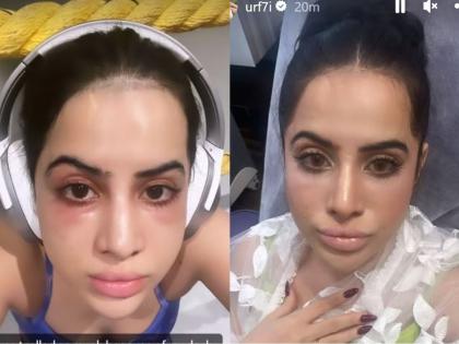 uorfi javed under eye filler lip filler horribly gone wrong actress shared weird face photo on instagram | Uorfi Javed : अरेरे! उर्फी जावेदच्या चेहऱ्याची वाईट अवस्था; ट्रोलिंगला कंटाळून नको ते केलं, आता होतोय पश्चाताप