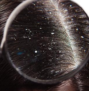 Home remedies to cure Dandruff naturally