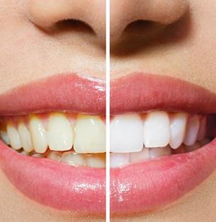 दात पिवळे, चिकट झालेत? १ चुटकी मिठात 'हा' पदार्थ मिसळून दात घासा, पांढरेशुभ्र दिसतील दात