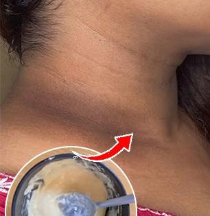 १ चमचा बेसन आणि ४ गोष्टी, चेहऱ्यावरचे बारीक केस-डलनेस सगळं गायब झटपट-पाहा उपाय