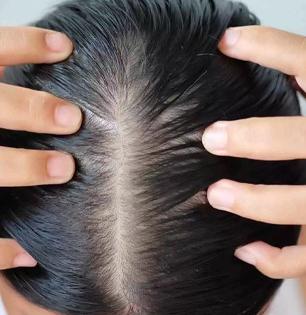 रोजच्या केस गळतीने टक्कल पडण्याची भिती? नारळाचं तेल 'या' पद्धतीने केसांना लावा, लांब होतील केस