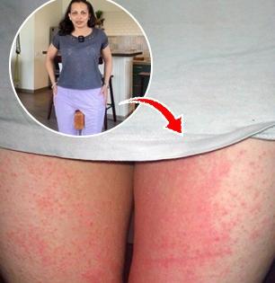 चालताना मांड्या घासल्या जातात-आग होते? ऋजुता दिवेकर सांगतात १ उपाय; जळजळ होईल दूर