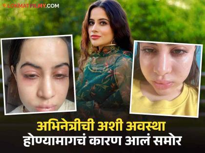 Swollen face, lips and eyes; Fans were shocked to see Uorfi Javed's photos | सूजलेला चेहरा, ओठ आणि डोळे; उर्फी जावेदचे फोटो पाहून चाहते झाले हैराण