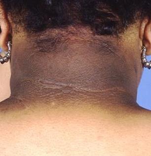 मानेवर मळाचे काळे थर दिसतात? १ चमचा बेसन 'या' पद्धतीने लावा, ग्लोईंग दिसेल स्किन