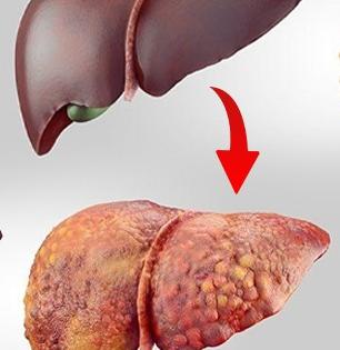 लिव्हर कॅन्सरचे संकेत देतात साधी वाटणारी ५ लक्षणं; वेळीच ओळखा हे बदल- पाहा काळजी काय घ्यायची