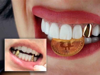 people are prefering metal teeth over Gold or silver | दात कशाचे; सोन्याचे, चांदीचे की सिमेंटचे ?