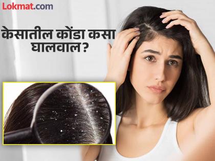 How to get rid of dandruff? Do this remedy once without shampoo, oil or soap | केसातील कोंडा कसा घालवाल? शॅम्पू, तेल किंवा साबण सोडून एकदा करा हे उपाय