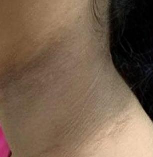 ऐन सणासुदीला मान काळवंडलेली दिसो? चमचाभर बेसनात 'हा' पदार्थ कालवून लावा; चमकेल मान