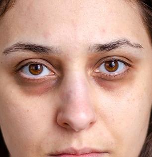 डार्क सर्कल्स पिच्छा सोडत नाहीत? पाहा हमखास काय चुकतं आणि काय करायला हवं.