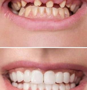 दात पडला, किडला म्हणून काढून टाकला तर पुढे काय? पाहा स्माइल सुंदर करणारा ‘हा’ उपाय..