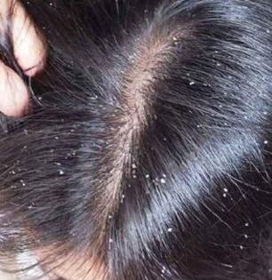 डोक्यात खूपच कोंडा झाला? करा सोपा उपाय, ८ दिवसांत कोंडा गायब आणि केस होतील चमकदार