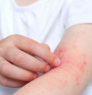 चुका टाळा! रोजच्या 'या' ५ सवयींमुळे होऊ शकतं स्किन इन्फेक्शन; उन्हाळ्यात दहापट वाढतो धोका