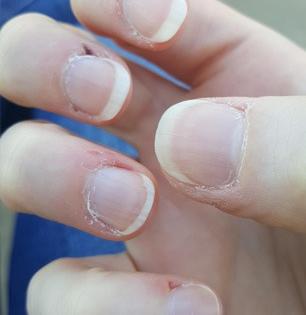 नखाच्या आजुबाजुची त्वचा कोरडी पडून सालं निघतात- रक्त येतं? पाहा यामागची कारणं आणि उपाय..