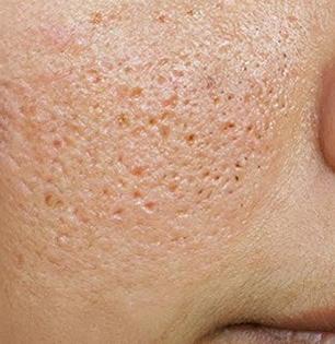 ओपन पोर्समुळे चेहरा म्हातारा-उदास दिसतो? ७ नैसर्गिक पदार्थ लावा, चेहऱ्यावर येईल तरुण चमक...